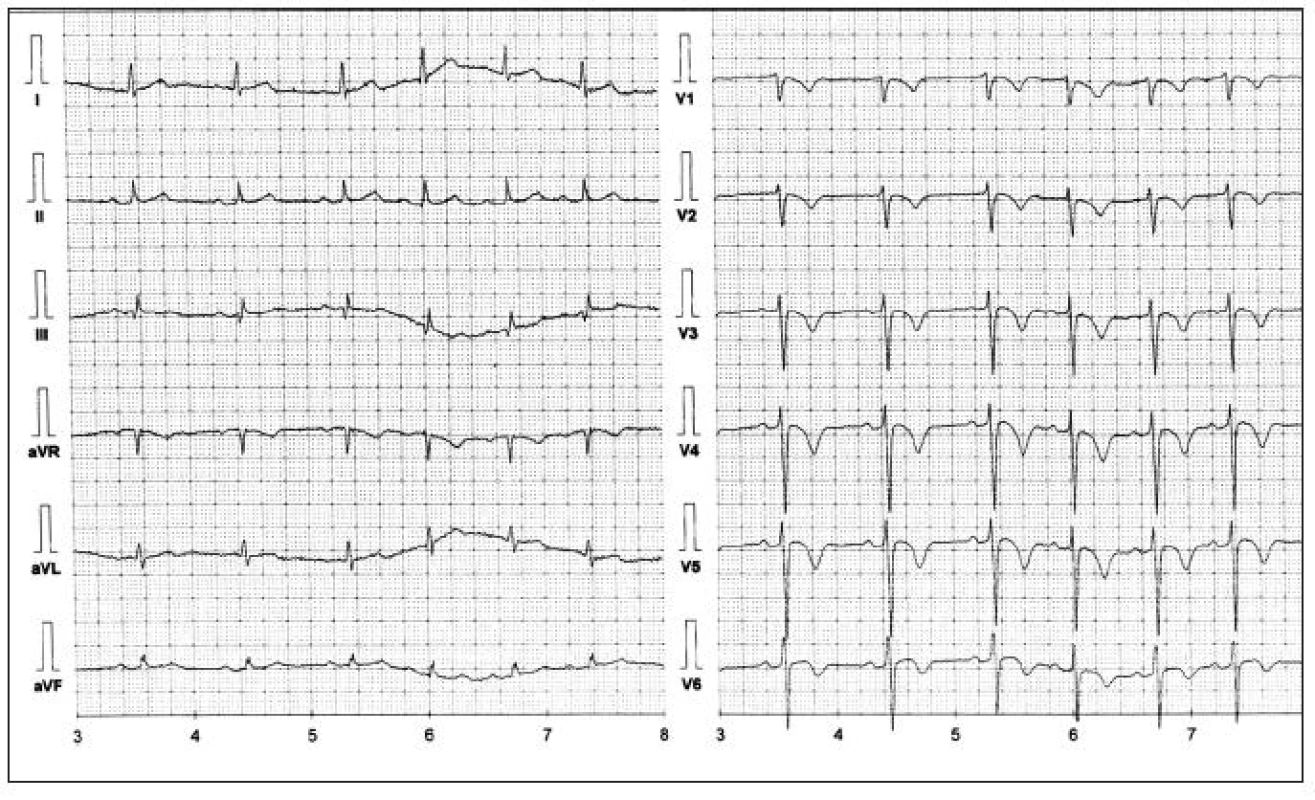 EKG změny při embolizaci do plicnice jsou nespecifické (symetrické negativity vln T ve svodech V1-V4 ze zatížení pravé komory, S ve svodu I, Q ve svodu III)