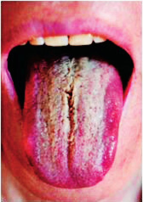 Prechod patologicko-zmnoženého povlaku do žltých nakopenin filiformných papíl, z ktorých v strednej ryhe tela jazyka sa diferencuje linqua vilosa žltej farby (Timková)