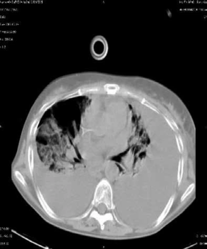 CT sken nemocného s kvasinkovou pneumonií