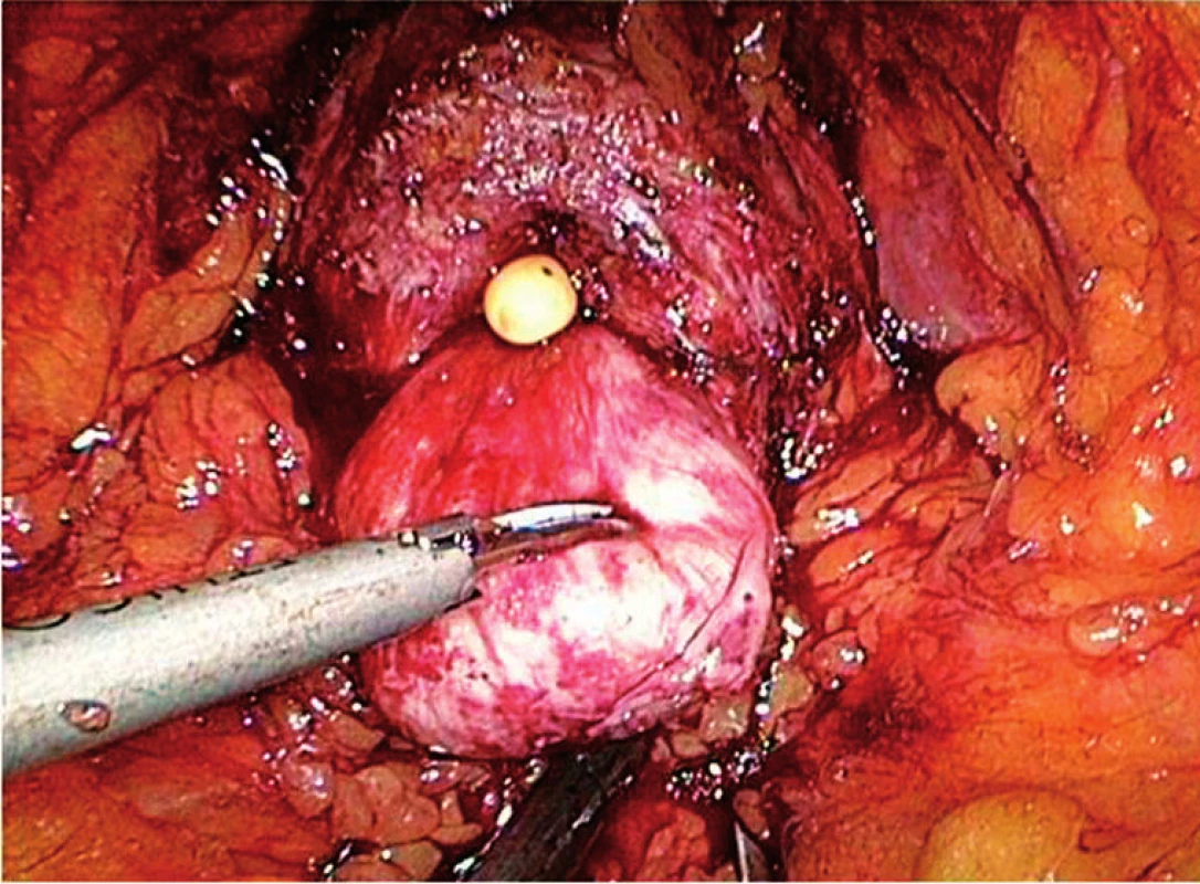 Velký střední lalok prostaty po oddělení předního obvodu hrdla močového měchýře
Fig. 4. Large prostatic middle lobe after incision of the bladder neck anterior wall