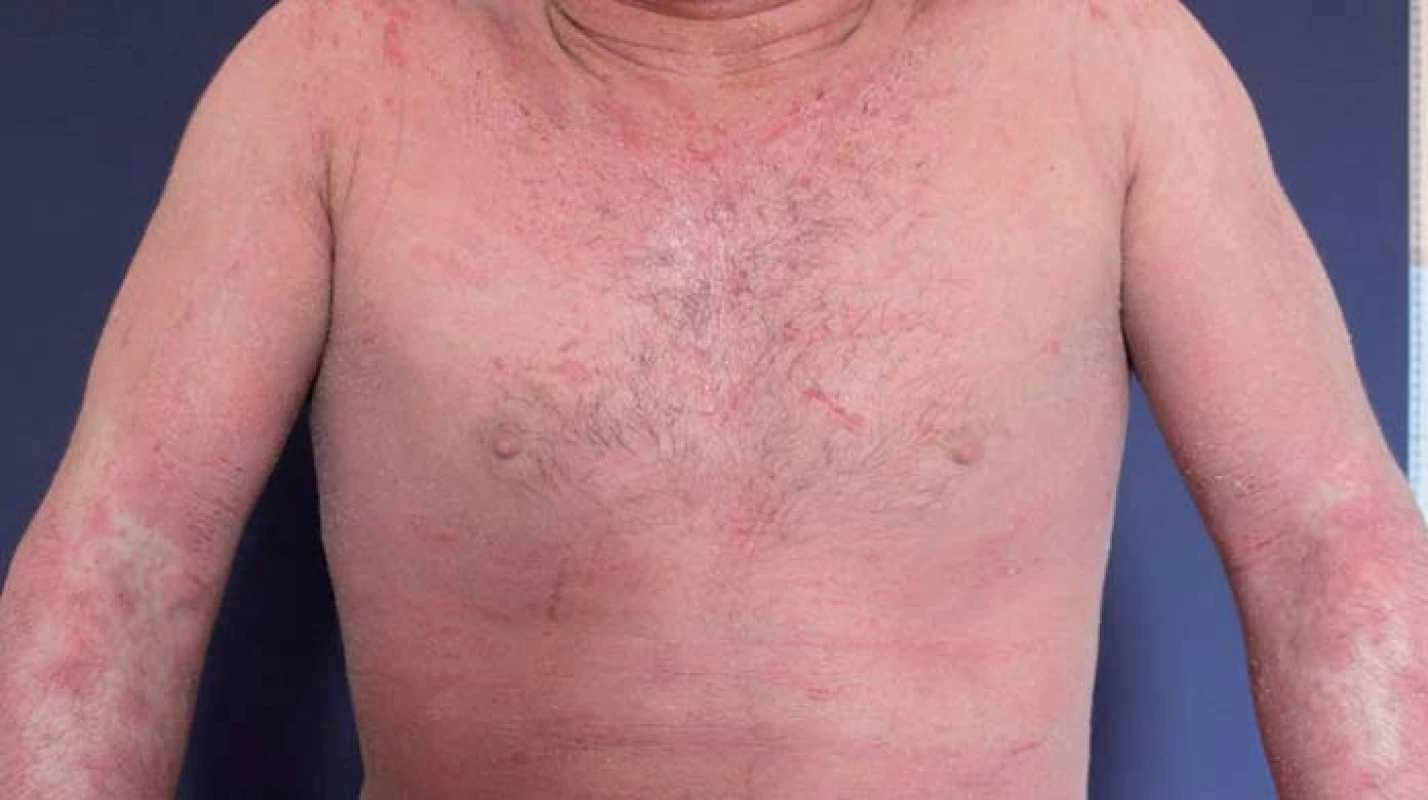 Atopická dermatitida.
Fig. 4. Atopic dermatitis.