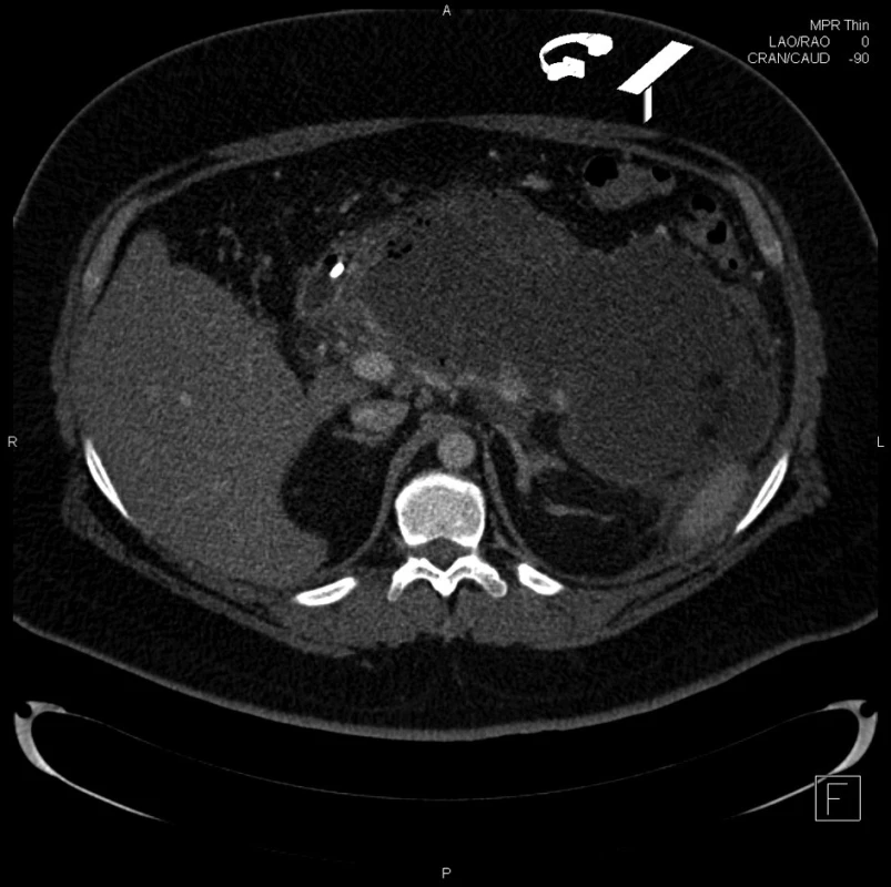 CT obraz rozsáhlé nekrózy pankreatu
Fig. 1: CT of extensive pancreatic necrosis