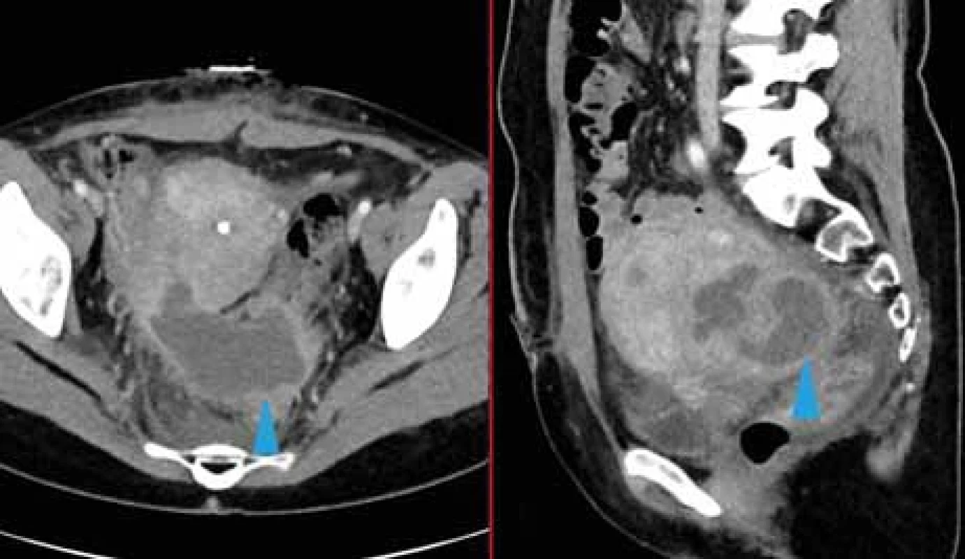 38letá pacientka po myomektomii. Zvětšená nehomogenní děloha, v zadní části se zdá být KT s mírně se sytícím lemem s podezřením na šíření kolekce mimo dělohu (modrá šipka). Při operaci žádná kolekce nenalezena. 