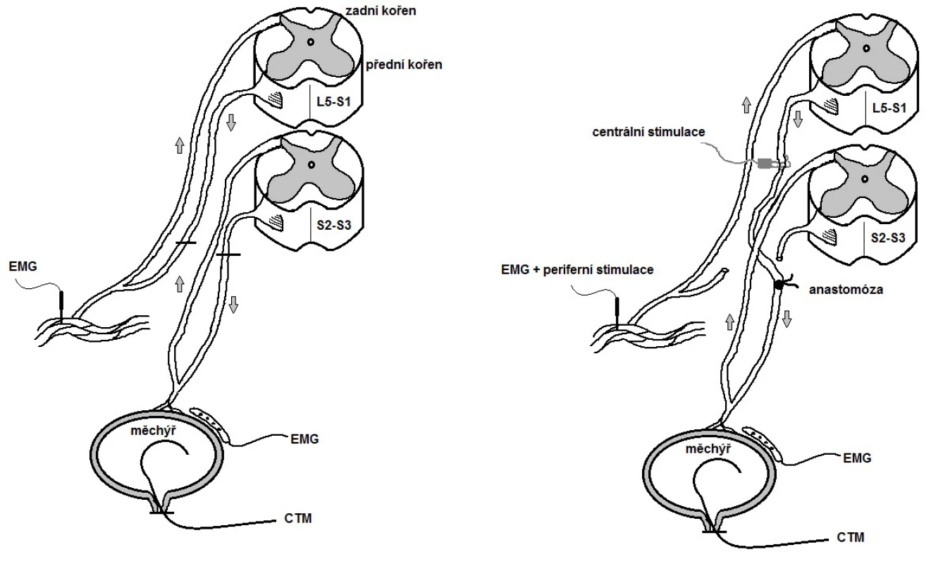 Schéma remodelace mikčního reflexního oblouku
Fig. 2. Scheme of artieficial skin-CNS-bladder pathway