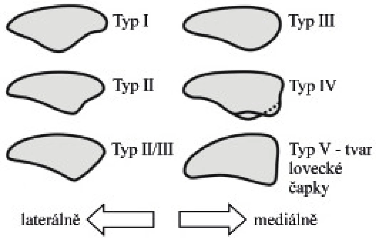 Wiberg-Baumgartlova klasifikace dysplazie pately.
Fig. 1. Wiberg-Baumgartl classification of patellar dysplasia.