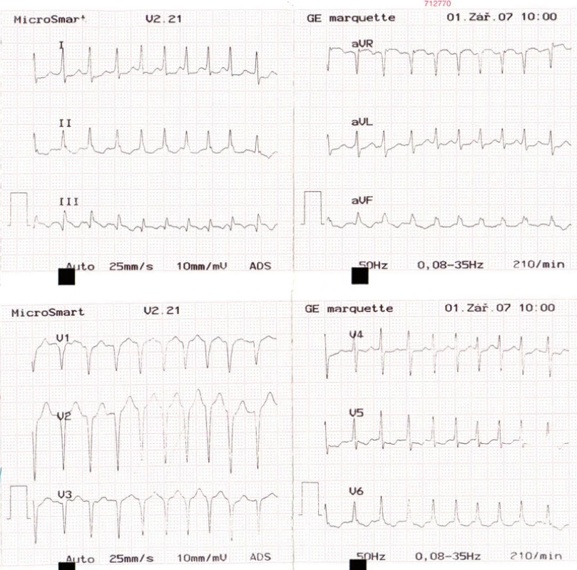 EKG – supraventrikulárna tachykardia s frekvenciou 210/min.