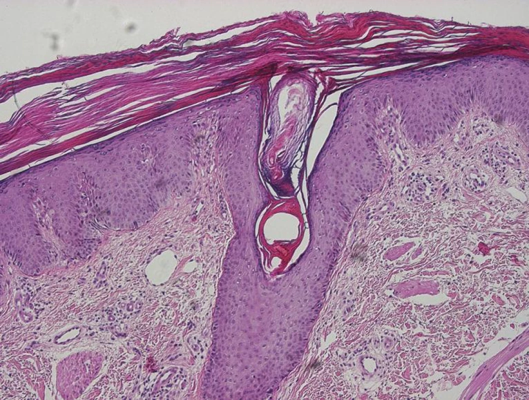 Klasická pityriasis rubra pilaris: folikulárně akcentovaná hyperkeratóza s šachovnicovitě se střídajícími úseky parakeratózy, hypergranulóza
