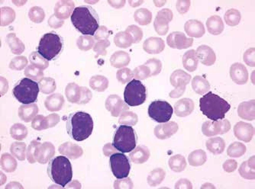 CLL, typický cytomorfologický nález (malé zralé lymfocyty s nevelkým množstvím cytoplazmy a hutným jaderným chromatinem), periferní krev, barvení Maye-Grünwalda, Giemsy-Romanowského