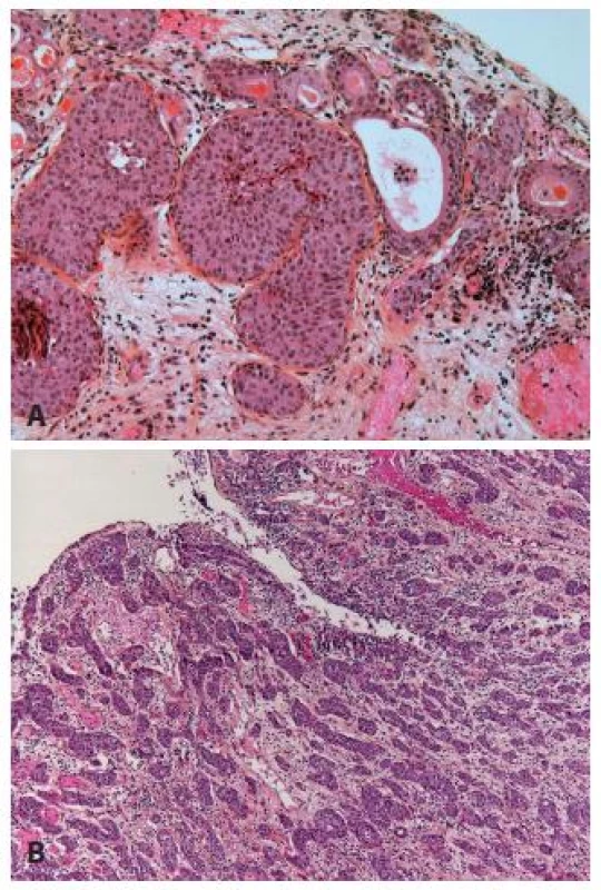 A. Superficial infiltrating nested carcinoma. In case when no muscle is present, new TURB has to be done. B: Easily recognizable nested carcinoma with dense infiltration of the lamina propria.