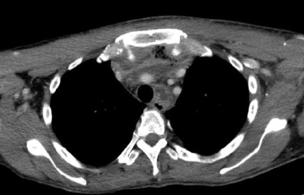 CT obraz - rozsáhlý absces zasahující do předního mediastina
Fig. 3: CT image – a large abscess spreading to the anterior mediastinum
