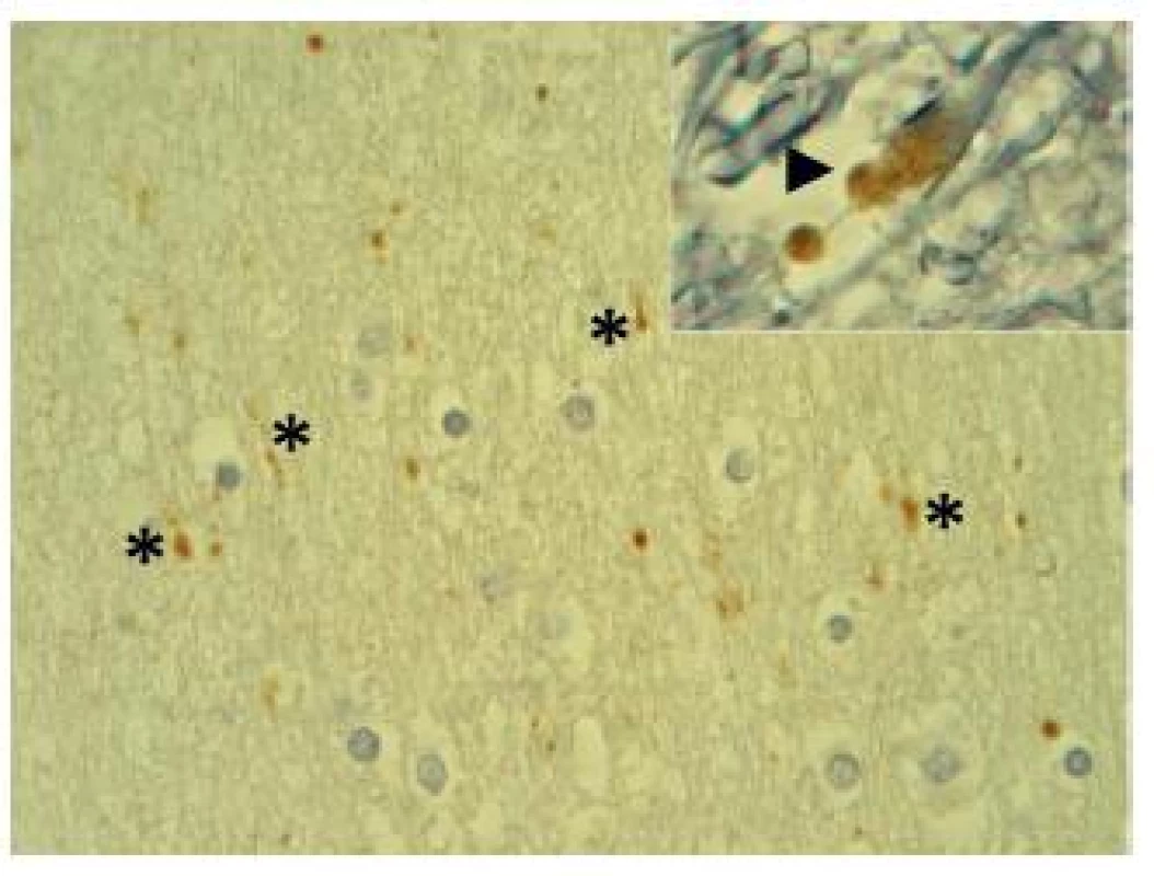 Wave-like and varicose axons (asterisk) with granular beta- amyloid precursor protein (β-APP) immunopositivity inside axoplasma. Axons have been appeared swollen and formed a bulblike retraction ball (arrowhead, see in detail).