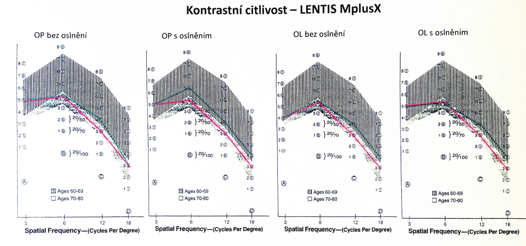 Hodnoty kontrastní citlivosti ve skupině B (implantace Lentis MplusX)