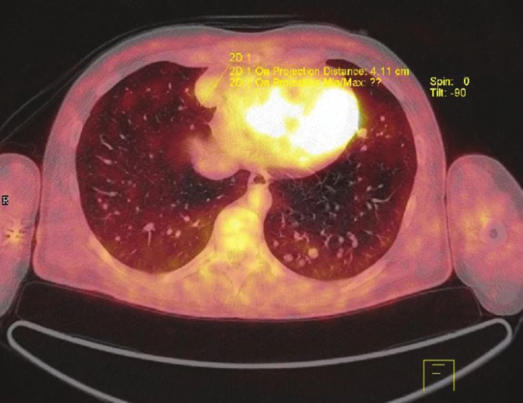 PET/CT Mnohočetné plicní metastázy maligního melanomu
Fig. 3: PET/CT Multiple melanoma metastases to the lung