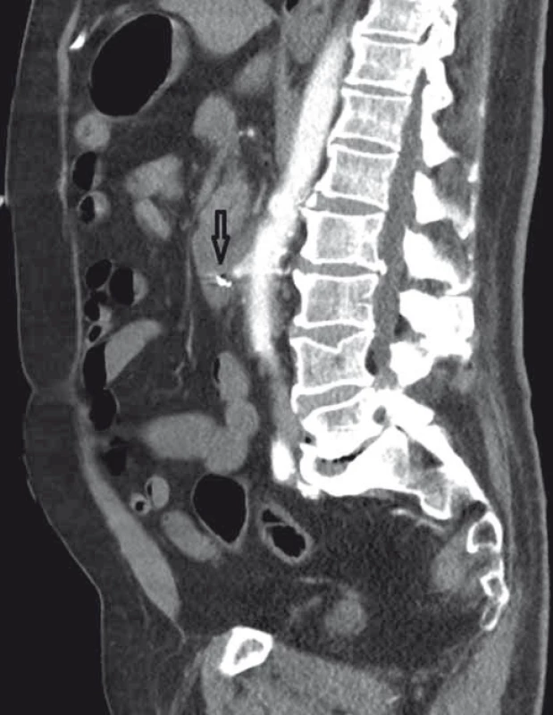 CT angiografie, boční zobrazení, arteriální fáze (šipka ukazuje píštěl).
Fig. 4. CT angiography, lateral view, arterial phase (the arrow points to the fistula).