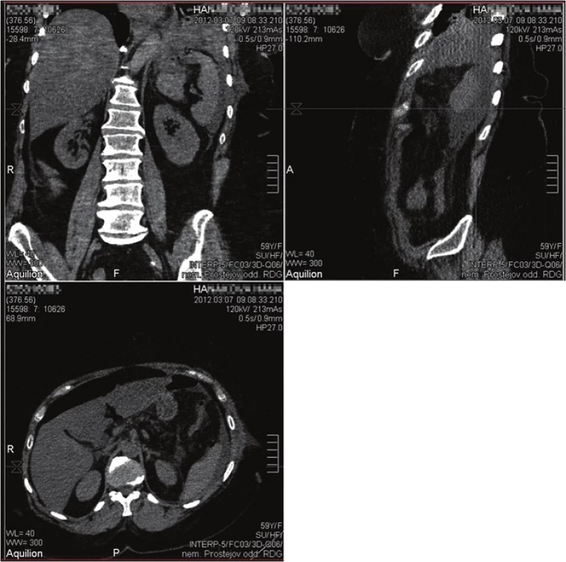 CT s nálezem akutní kolekce v levém podžebří
Fig. 2: CT scan with the finding of an acute left subphrenic collection