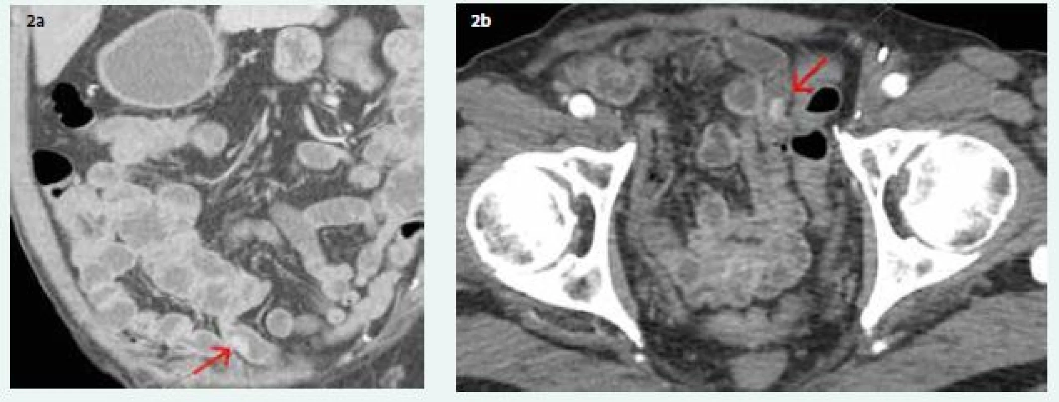 a, 2b. Contrast enhanced CT: a (coronal scan) and b (transversal scan) hypervascularised lesion on ileal
bowel loop (red arrow)