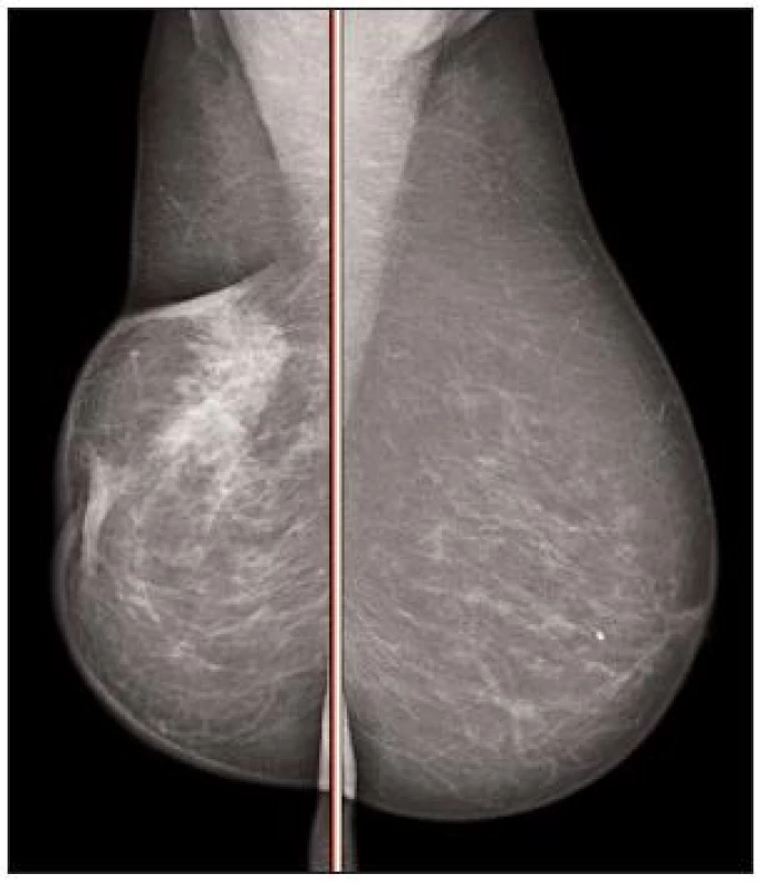Mamografie pravého prsu
Fig. 6. Mamography of the right breast