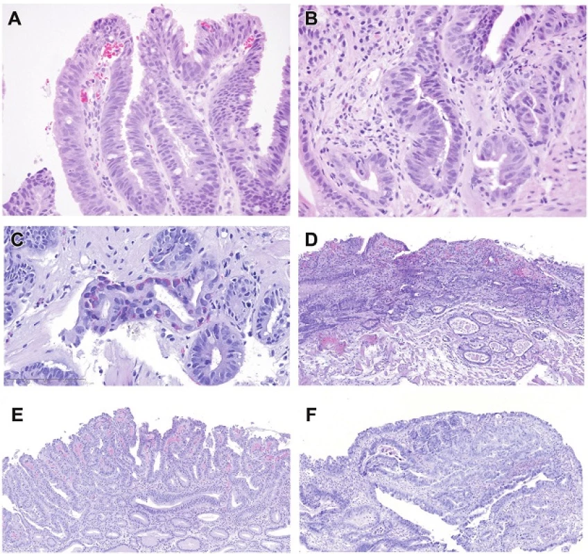 Intestinal type high-grade dysplasia. Goblet cells are easily seen in this example, which shows stratified nuclei reaching the luminal surface. H&amp;E (200x). B. There is also a transition to rounded more pleomorphic nuclei and loss of nuclear polarity (bottom left). H&amp;E (400x). C. This image shows not only loss of nuclear polarity of round pleomorphic nuclei and a goblet cell, but there is neuroendocrine differentiation (Kulchitsky type cells) in the center of the field, a feature that probably informs the capacity of Barrett-associated columnar epithelial dysplasia to give rise to neuroendocrine carcinomas, as seen also in the colon. It is noteworthy that Barrett’s epithelium often has a greater density of neuroendocrine cells than stomach or colon. H&amp;E (400x). D. Mucosal carcinoma. Note that the atypical tubules extend laterally. Some contain luminal necrosis (those in the inner muscularis mucosae). H&amp;E (40x). E. In this example of intramucosal carcinoma, tiny tubules proliferate between normally sized tubules and some of the glands show lateral expansion H&amp;E (100x). F. In this example of intramucosal carcinoma, the disturbed gland architecture is the key to separating the findings from those of high-grade dysplasia. There is no desmoplasia. H&amp;E (100x).