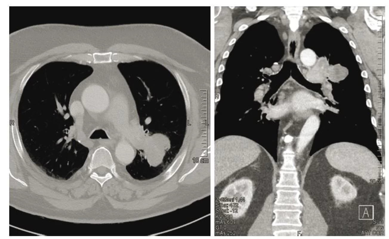 Vstupní nález tumorózní
infiltrace levého plicního pole