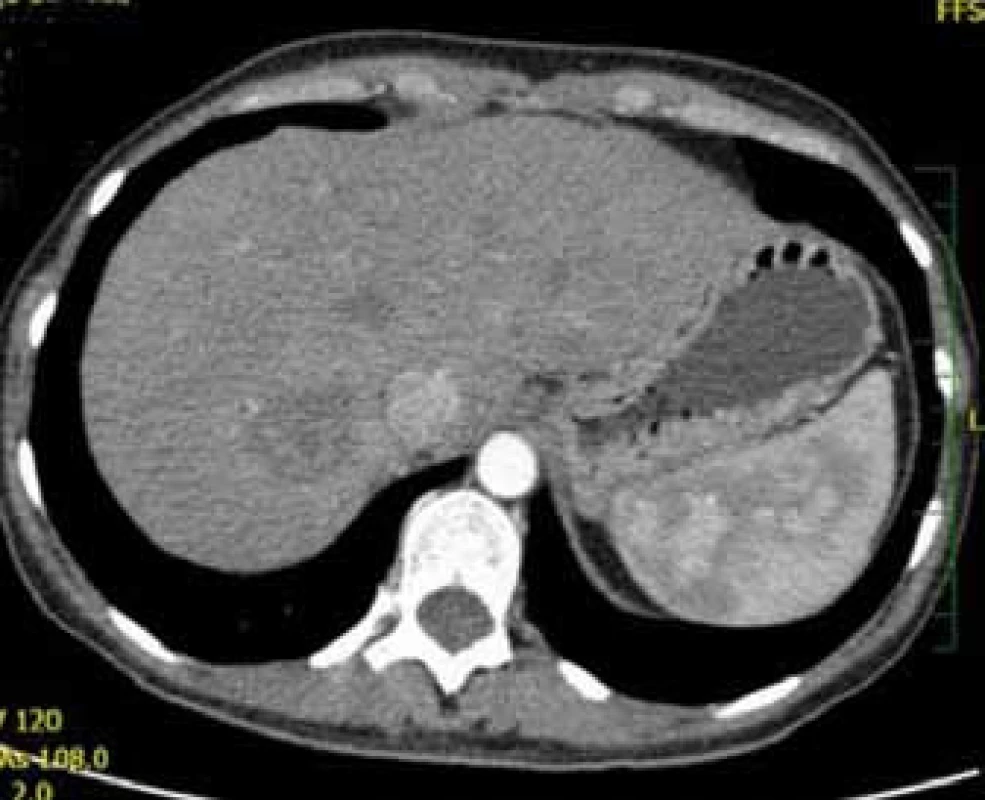 Trojfázové CT jater: arteriální fáze.
Fig. 3. Contrast CT of liver: arterious phase.