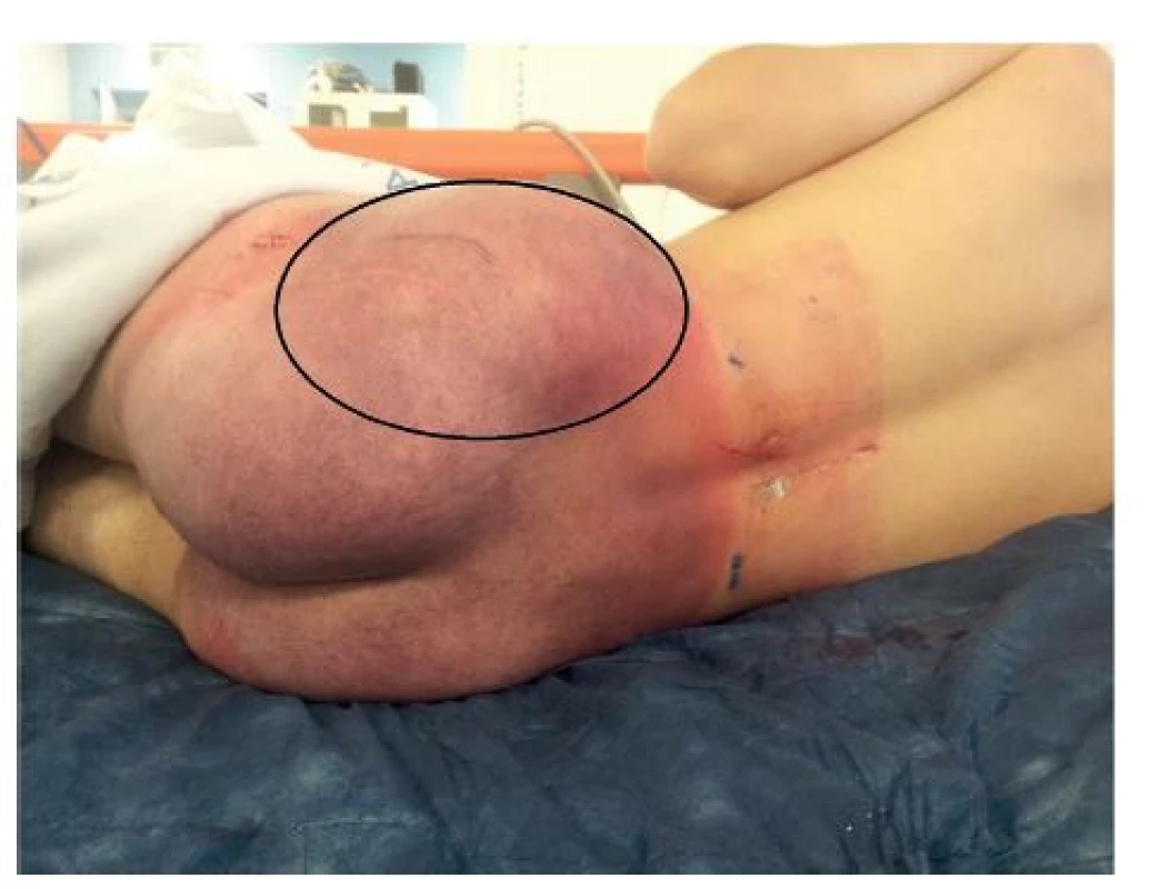 Obr. 2: Rozsáhlá podlitina (“cucflek“) v oblasti hýždě s elastickou rezistencí vlevo
Fig. 2: Large sufusion (“lovebite“) of gluteal area with elastic swelling
