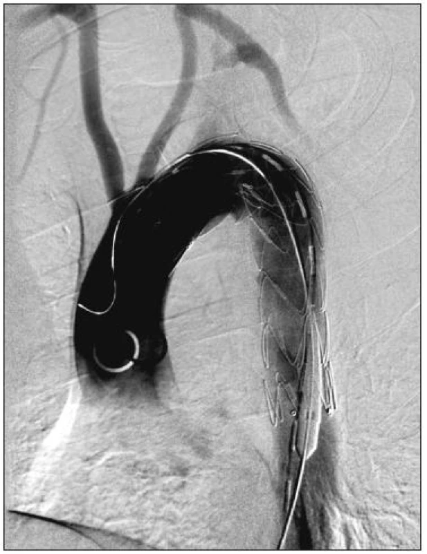 54-ročný muž s aneuryzmatickou dilatáciou anomálne odstupujúcej arteria subelavia dextra (arteria lusoria).
Stav po implantácii hrudného stentgraftu do oblasti aortálneho oblúka. Digitálna subtrakčná angiografia aortálneho oblúka a supraaortových vetiev.
Fig. 4. A 54-year old male with aneurysmal dilatation of an abnormal arteria subclavia dextra (arteria lusoria). Following thoracic stentgraft implantation into the aortic arch region. Digital subtraction angiography of the aortic arch and supraaortic branches.