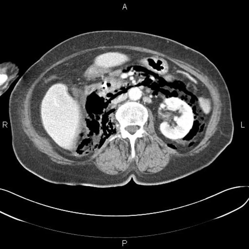 CT vyšetření: pneumoretroperitoneum, perforační komplikace při divertikulóze