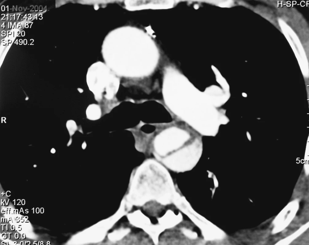 CTA obraz disekce typu B
Pic. 1. A CTA view of the type B dissection