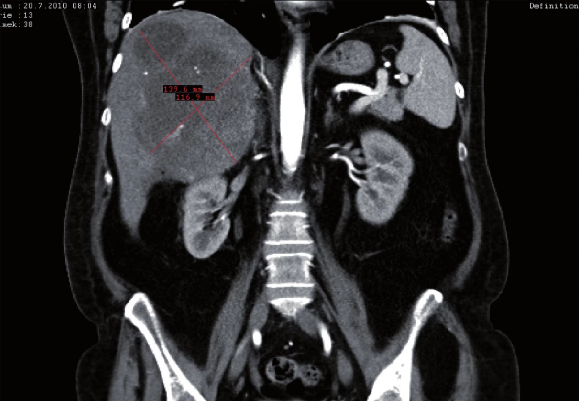 CT vyšetření v září 2010, největší rozměr tumoru jater 140 x 117mm (frontální řez).