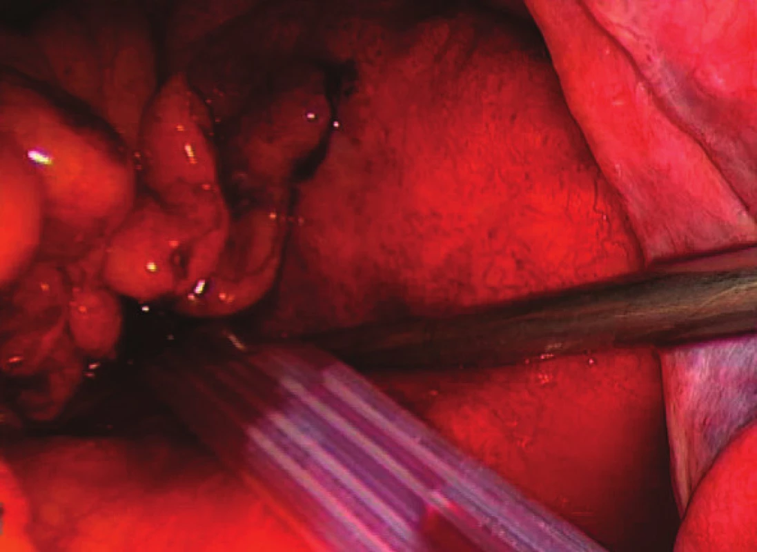 Nález po laparoskopickém ošetření
Fig. 2: The same patient after laparoscopic lavage and drainage