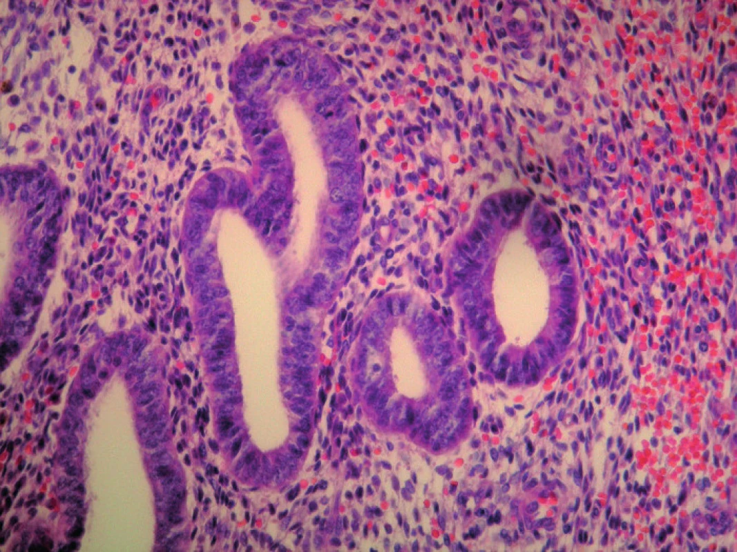 Detailný záber na endometriálne žliazky a endometriálnu strómu s charakteristickým intersticiálnym čerstvým krvácaním, HE 400x
Fig. 4: Endometrial tissue, cells and stroma with characteristic interstitial bleeding, detailed view, HE 400x 