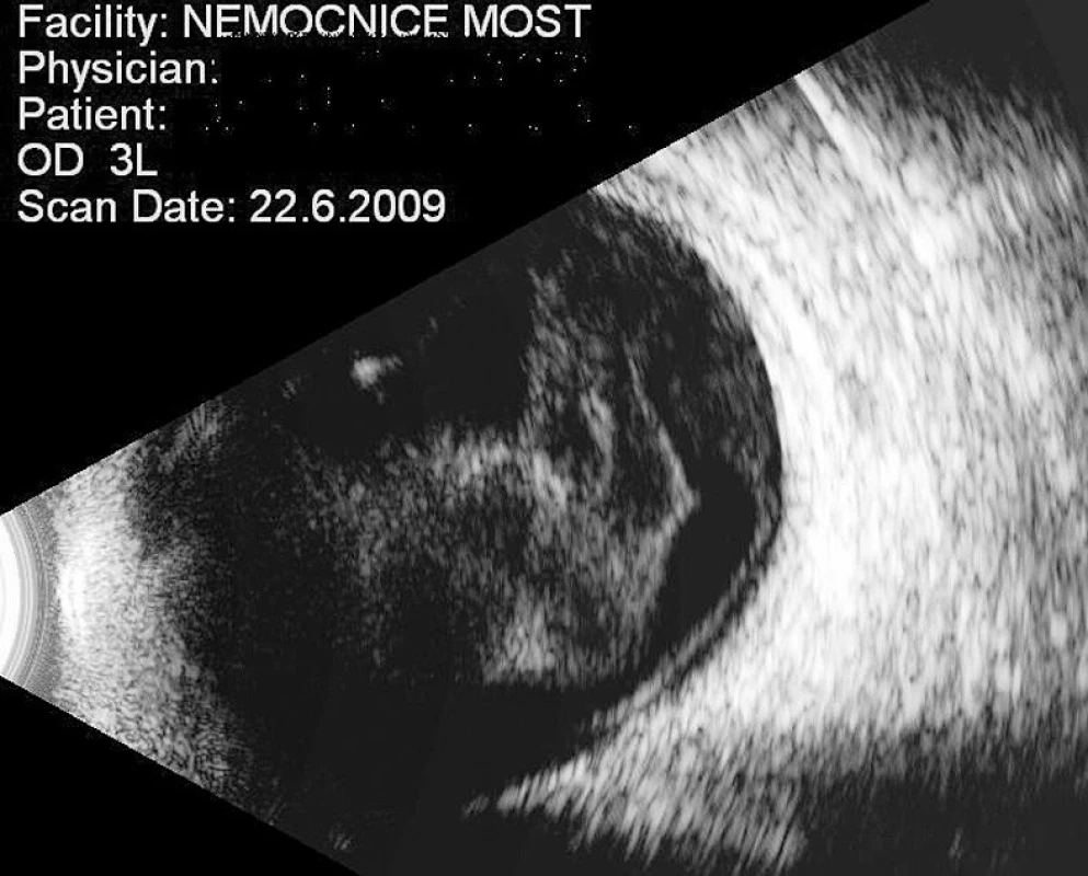 Pacientka č. 3 – Sítnicové a sklivcové změny v ultrazvukovém obraze (červen 2009)