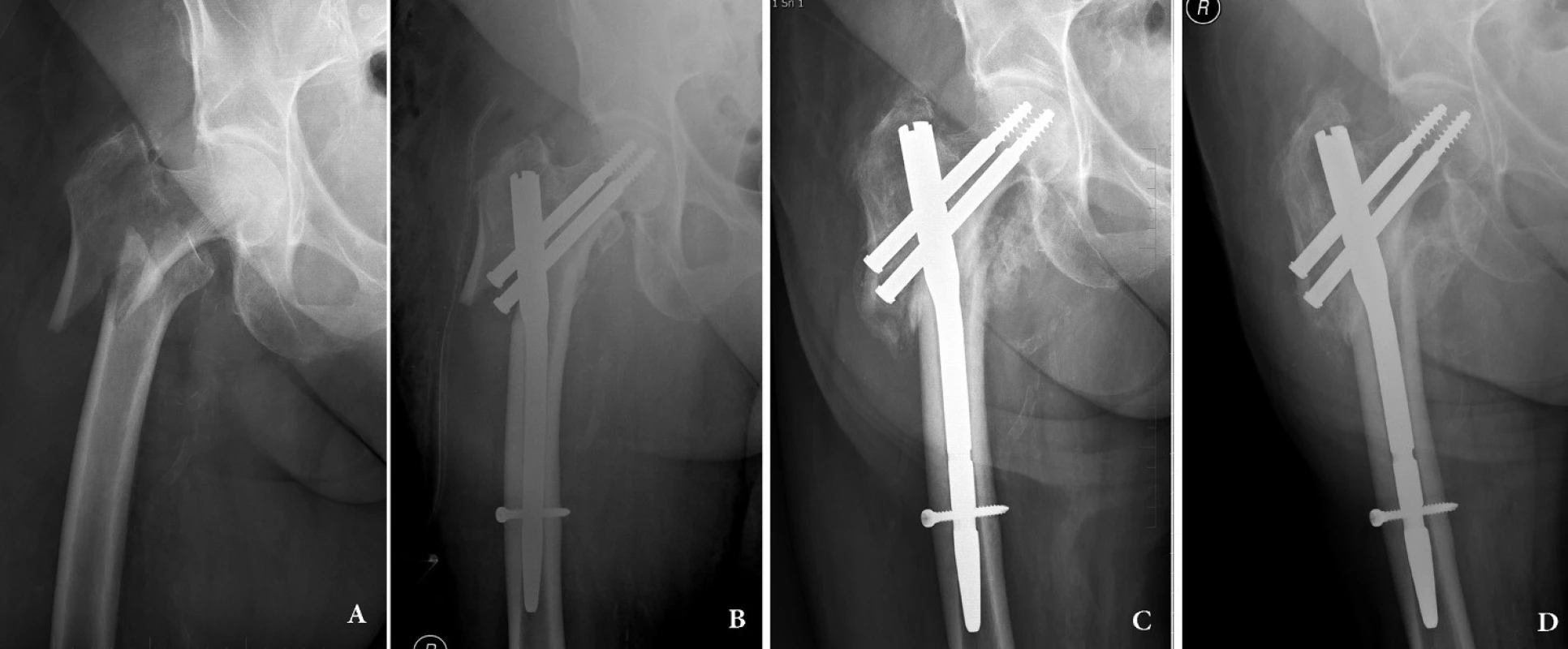 Intertrochanterická zlomenina 31–A3: a – úrazový snímek; b – osteosyntéza krátkým rekonstrukčním hřebem Medin, hřeb je zajištěn dynamicky; c – ve 3 měsících se zlomenina hojí svalkem, je patrné dosednutí fragmentů; d – stav 12 měsíců po operaci, zlomenina je zhojená.
Fig. 1: Intertrochanteric fracture 31 – A3: a – injury x-ray; b – internal fixation by short reconstruction nail Medin with dynamic distal locking; c – compression of the two main fragments along the axis of the nail and callus formation in the fracture line; d – 12 months after surgery, the fracture is healed.