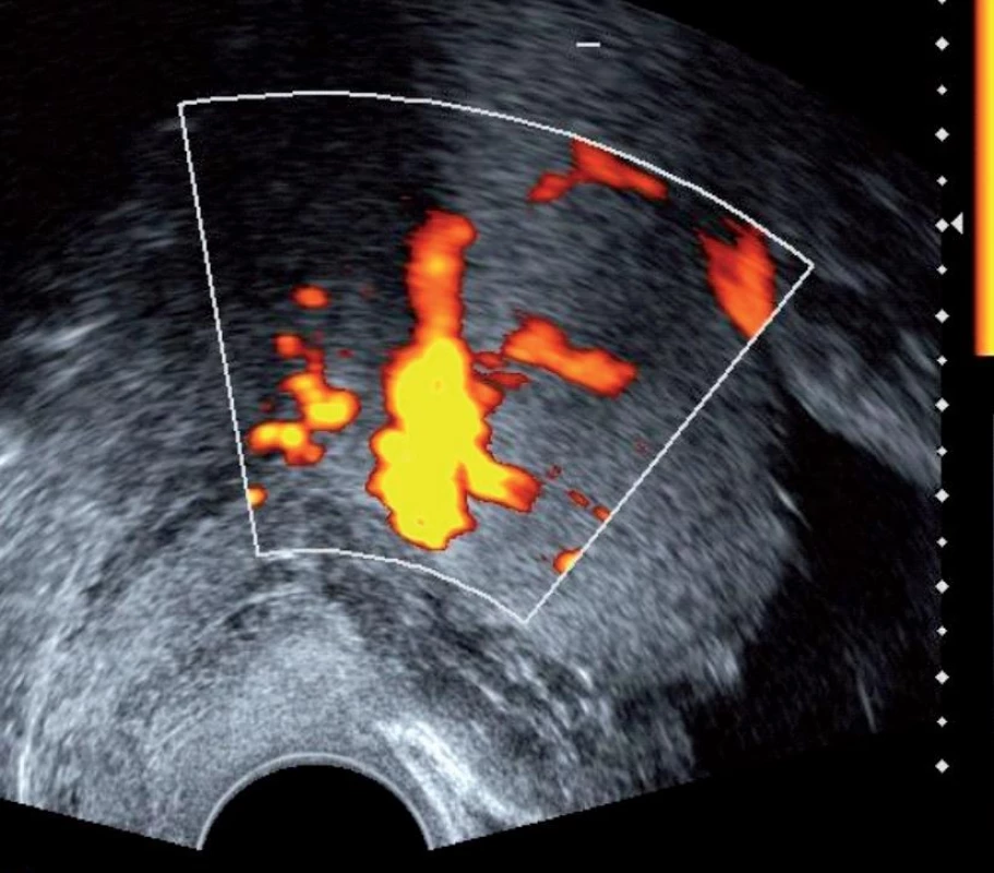 Hypervaskularizace mezi vzadu uloženou placentou a zadní stěnou děložní