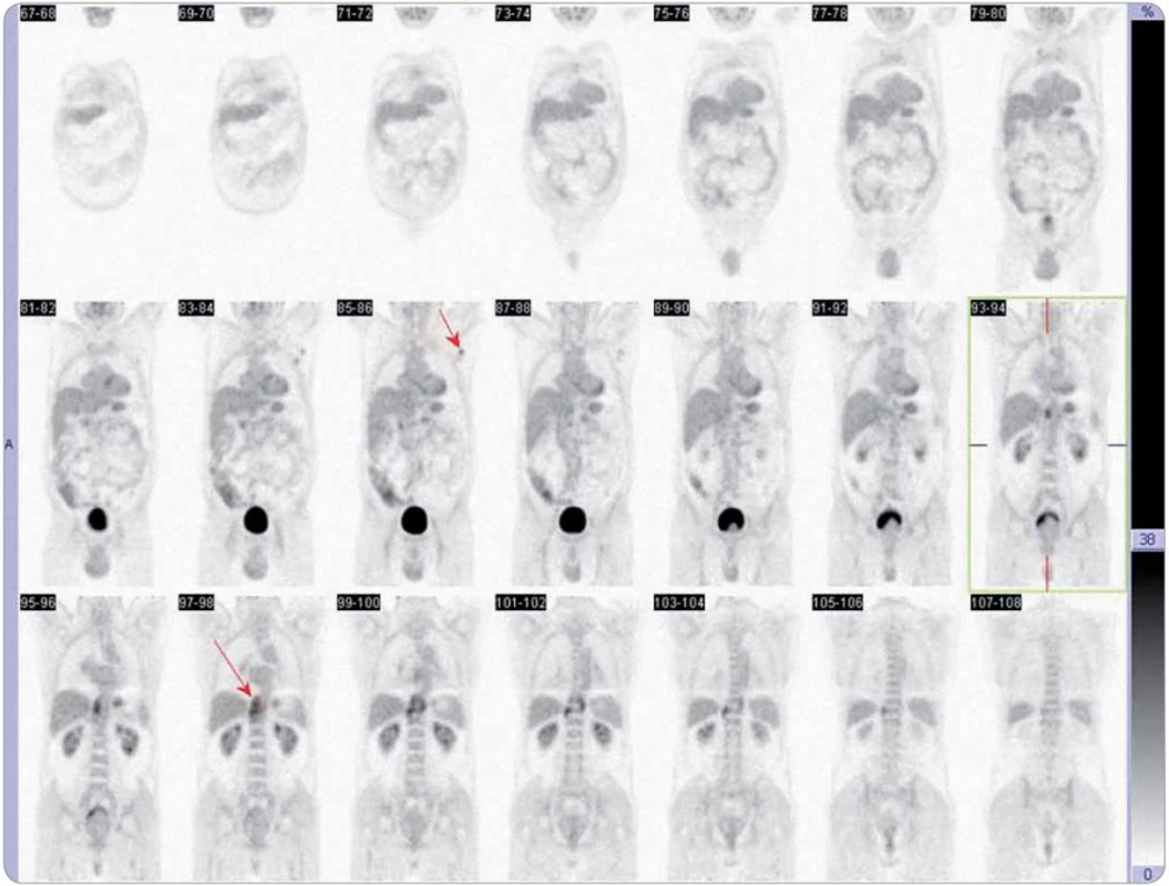 Obraz celotělového PET vyšetření při dalším relapsu onemocnění (6/2009). Šipky ukazují metabolicky aktivní uzlinu v levé axile a sledovaný retrokrurální infiltrát.
