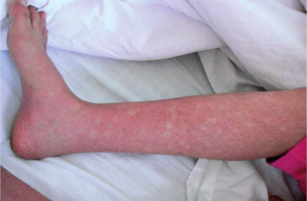 Kožní nález tzv. penízkovatění („white islands in a sea of red“) u pacienta s akutní horečkou dengue