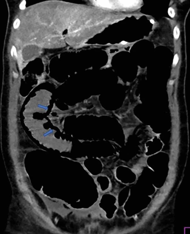 Pneumatóza steny čreva   Fig. 3: Pneumatosis of the intestinal wall