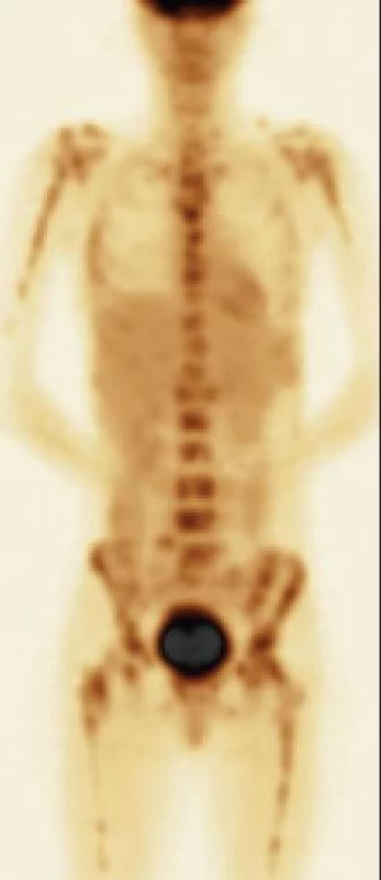 O patologické infiltraci skeletu, ale i mimo skelet, informuje pozitronová emisní tomografie.