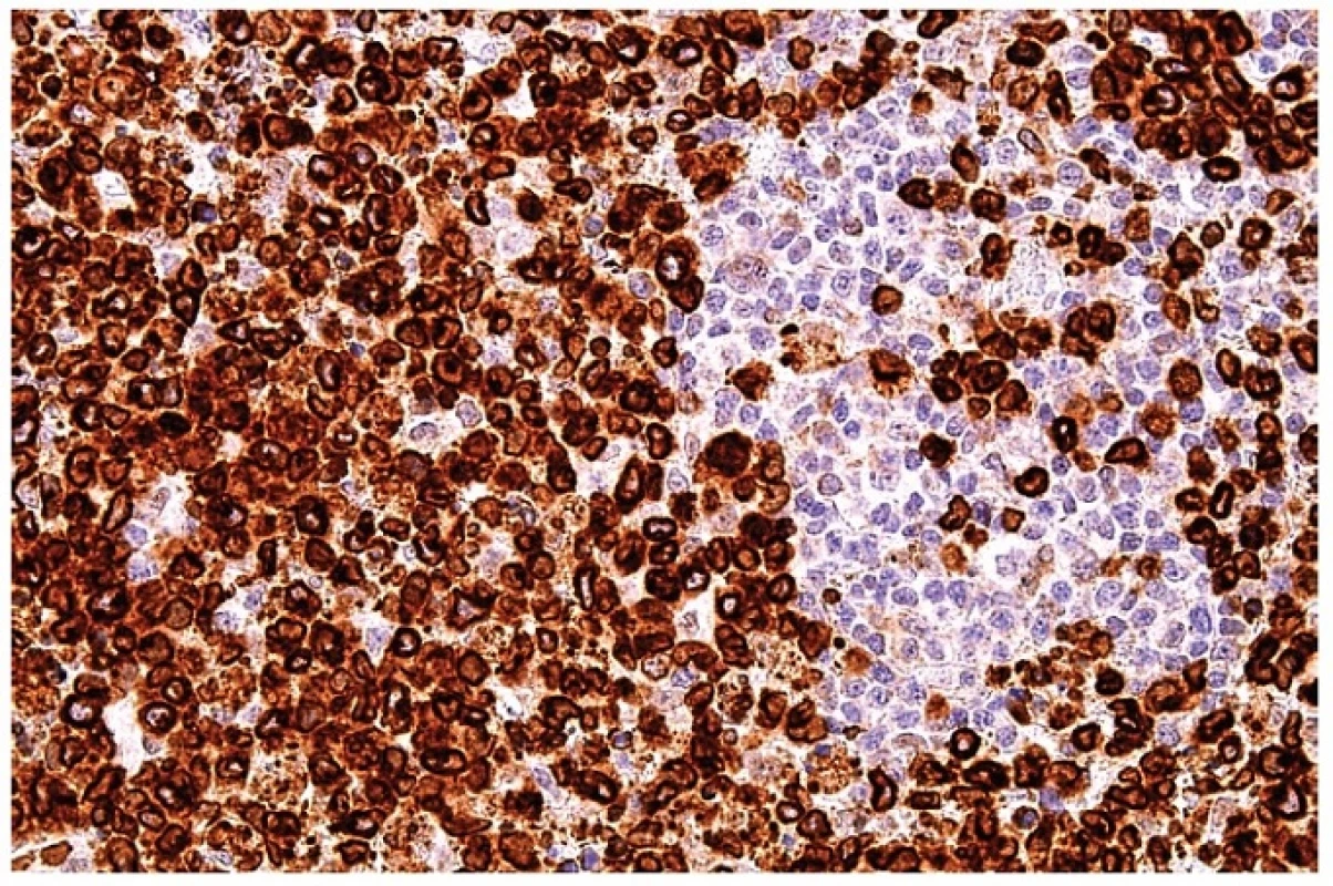 Průkaz perforinu v cytoplazmě blasticky aktivovaných T lymfocytů. Zbytkové populace B lymfocytární zóny jsou negativní. Imunohistochemická reakce, dobarveno hematoxylinem (zvetšení 200x).