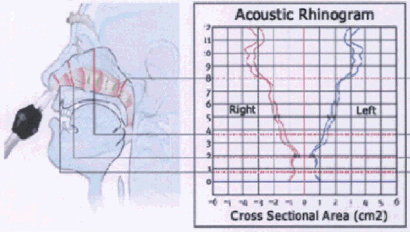 Akustický rinogram s grafickým znázorněním korespondujících oblastí v nosní dutině. Převzato z propagačních materiálů Interacoustics AS