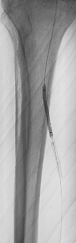 Implantovaný stent do arteria tibialis posterior na pravej dolnej končatine pre disekciu s výborným efektom
Fig. 4. A stent implanted into the posterior tibial artery on the right lower extremity for its dissection, with excellent outcome