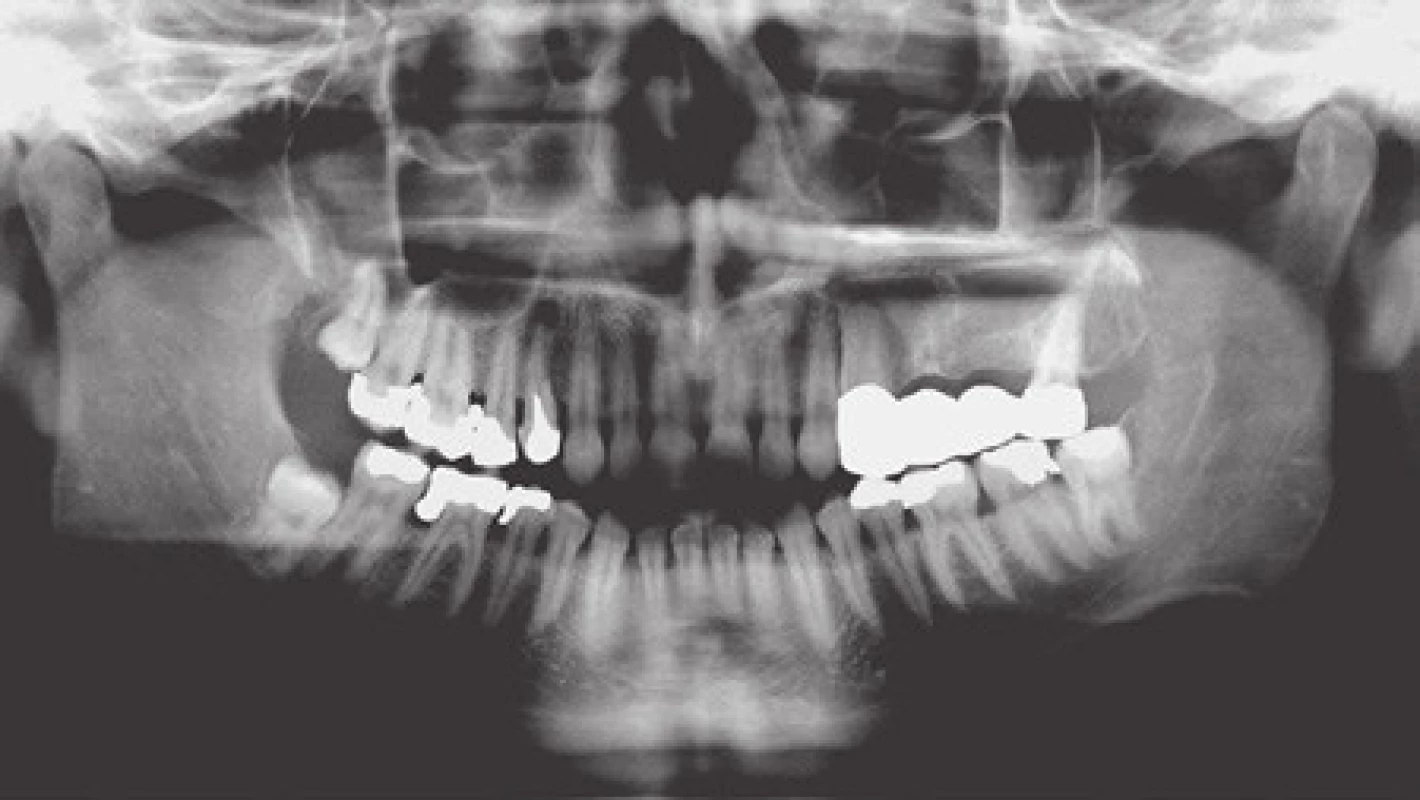 Přehledný rentgenový snímek chrupu zachycující horní i dolní čelist včetně části dutiny maxilární a dutiny nosní a čelistní klouby (tzv. ortopantomogram).