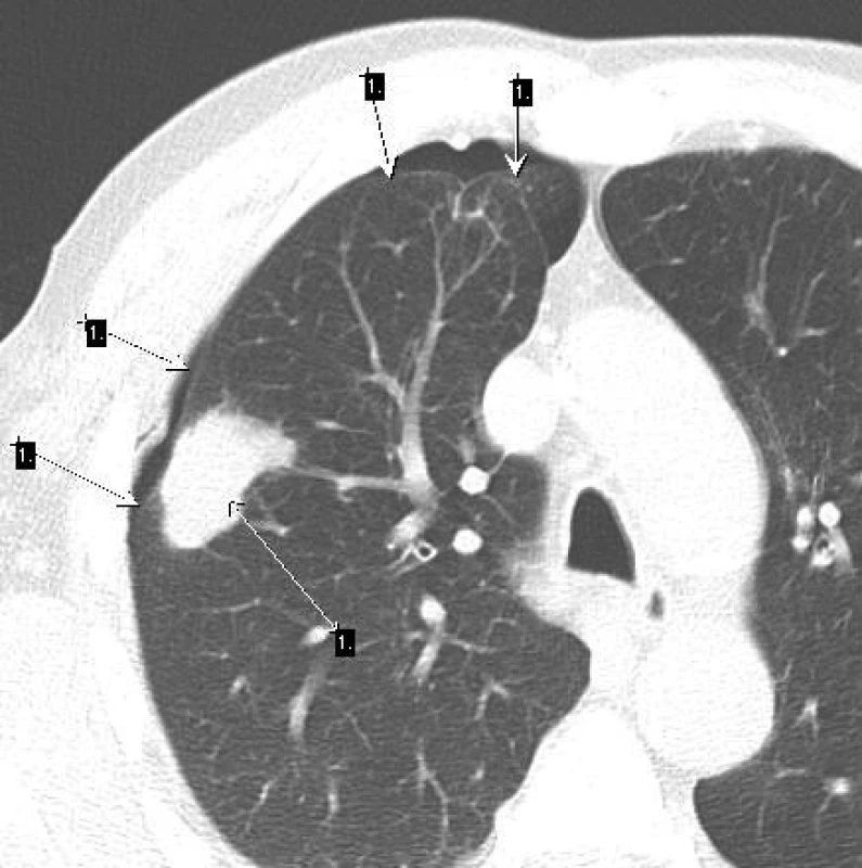 Pomalu rostoucí ložisko (šipka 1)
Po biopsii vznikl pneumothorax (šipky 2). Revmatoidní uzel.