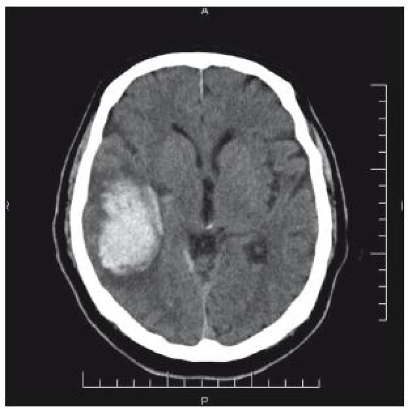 CT mozku: úrazový intracerebrální hematom temporálně vpravo. Přetlak středových struktur minimální.