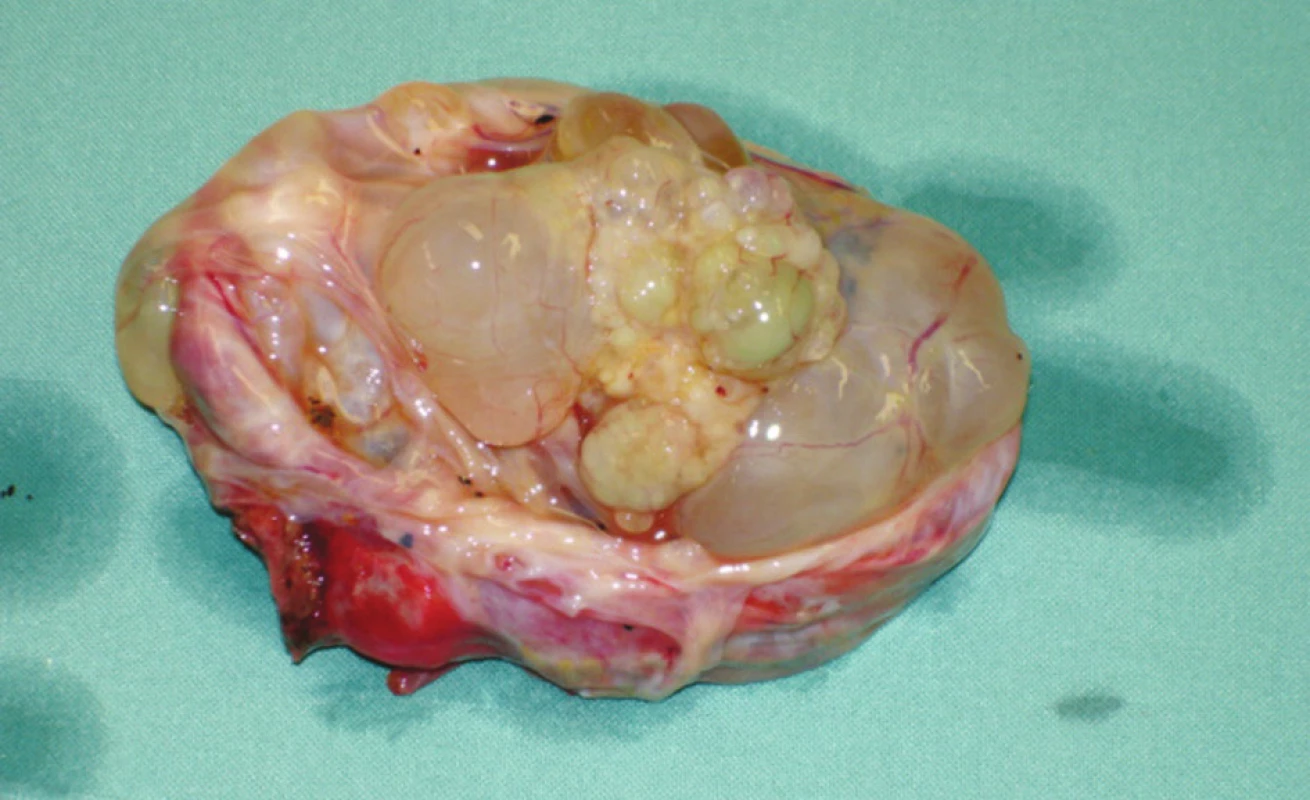 Cystadenom jater – preparát – případ 2 
Photo 1. Liver cystadenoma – a preparation – case No. 2
