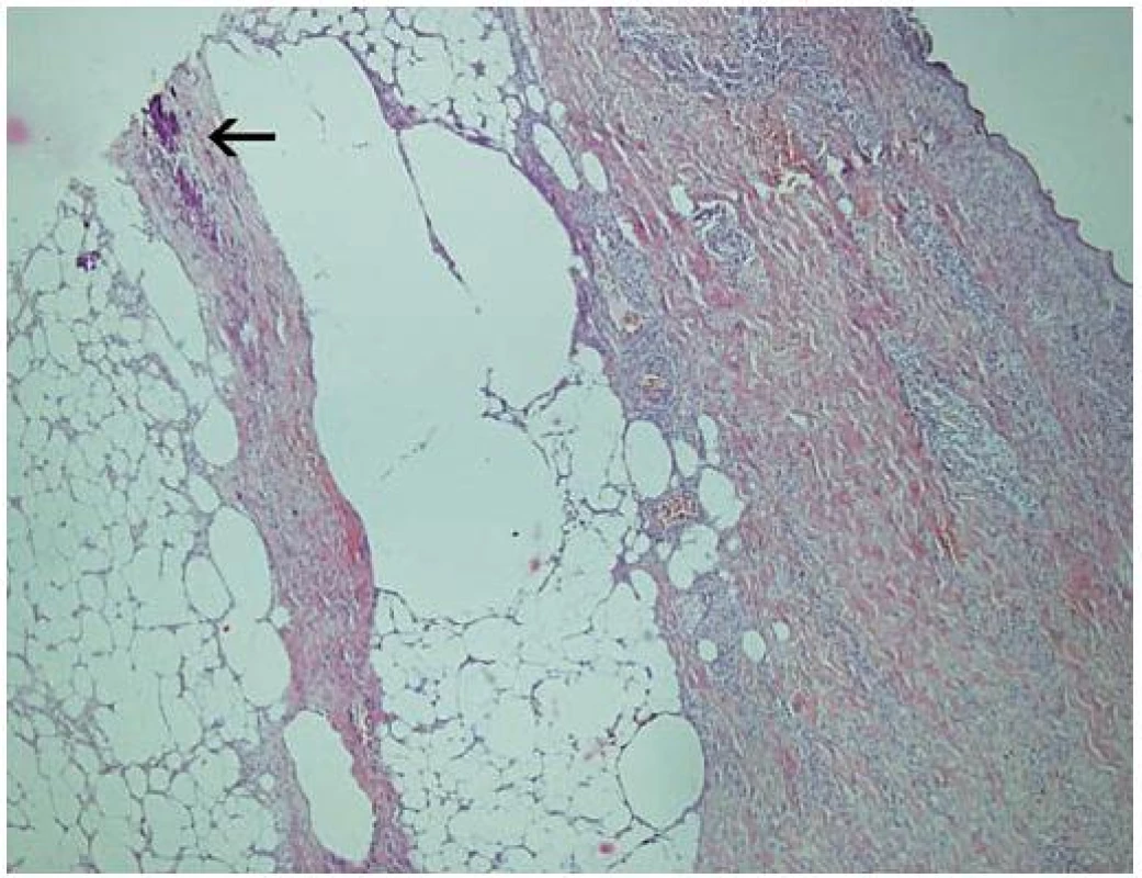 Histologický nález
Šipkou označeno bazofilní ložisko v septu subcutis odpovídající výrazné kalcifylaxi kolagenního vaziva, v přilehlémlobulu subcutis jsou lipofágy, v koriu jsou patrné extravazáty erytrocytů a zánětlivé infiltráty (zvětšení 40krát, barvení HE).
