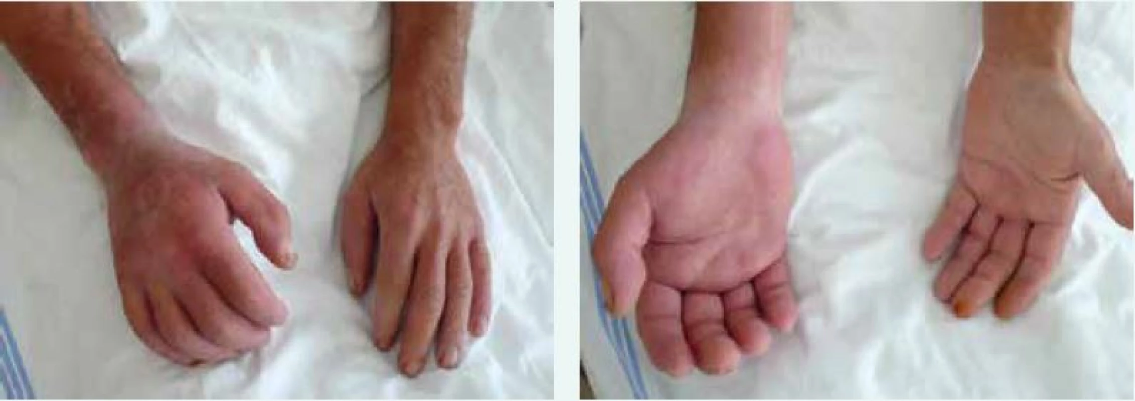 Sklerodermické postižení rukou a předloktí u nemocného se systémovou sklerodermií. Postižení je akcentováno pravostranně v souvislosti s profesním zatížením vibracemi pneumatického kladiva. Archiv autora