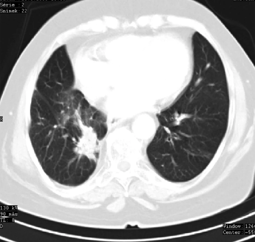 CT plic 6 měsíců po radioterapii se známkami postiradiační fibrózy v místě recidivy ložiska karcinomu
Fig. 6: Lung CT 6 months after radiotherapy with signs of post-irradiation fibrosis at the site of the tumour focus recurrence