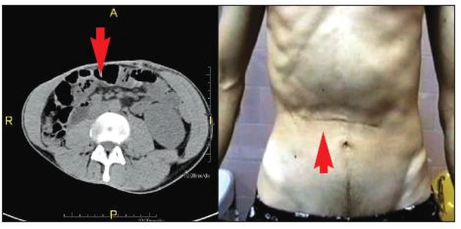Atrofie pravého m. rectus abdominis. 29letý pacient s pooperačním poškozením interkostálních nervů Th 8–10
vpravo. Na snímku vlevo je patrná výrazná atrofie pravého m. rectus abdominis (označeno šipkami) ve srovnání s levou stranou.  Atrofie je zřejmá i při pohledu na břišní stěnu v pravém horním břišním kvadrantu (snímek vpravo).