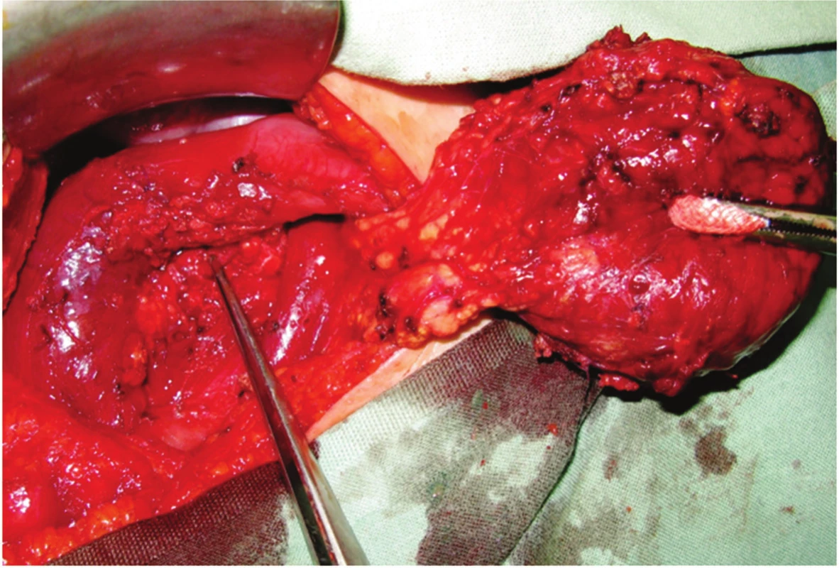 Tumor hlavy pankreatu (duodenum šetřící resekce hlavy pankreatu)
Fig. 2: Tumor of the pancreatic head (duodenum-preserving head resection of the pancreas)